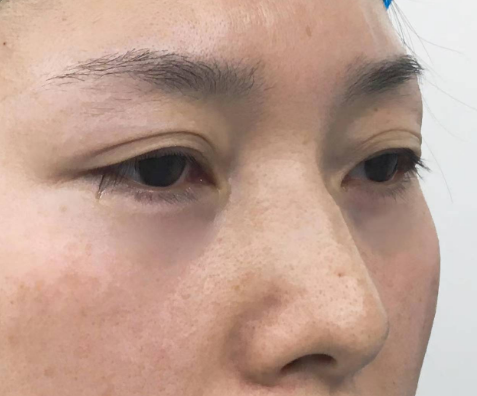 眼袋