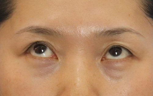眼袋