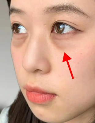 眼袋