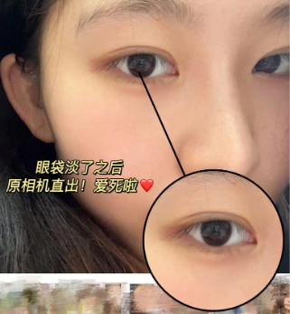 眼袋