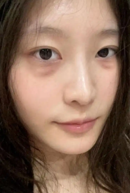 眼袋