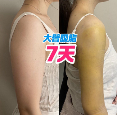 超声波减肥