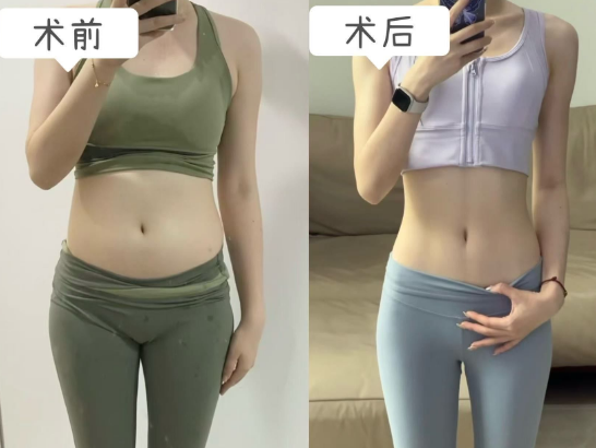 超声波减肥