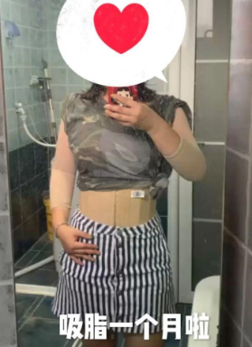 超声波减肥