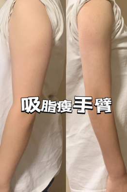 超声波减肥