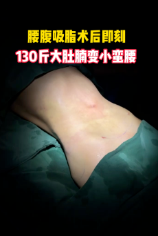 超声波减肥