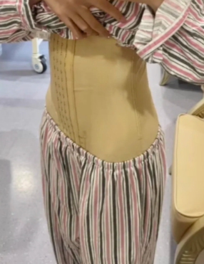 超声波减肥