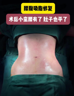 超声波减肥