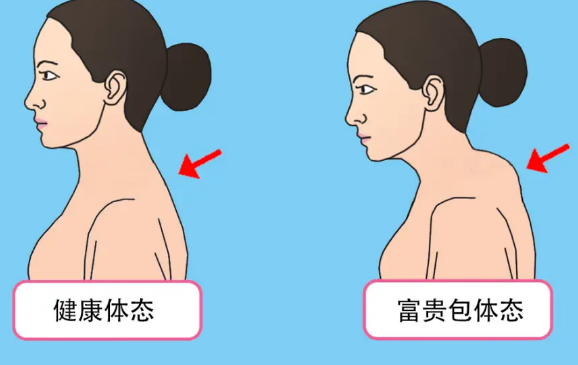 富贵包