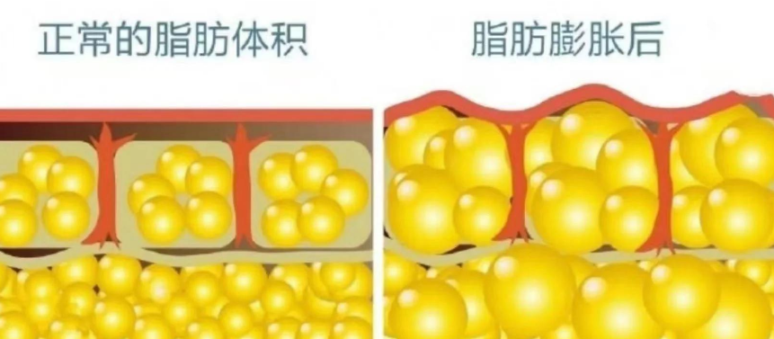 超声波减肥