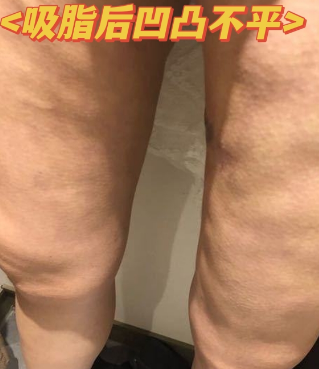 超声波减肥