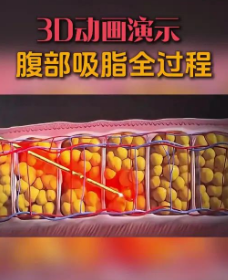 超声波减肥