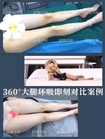 超声波减肥