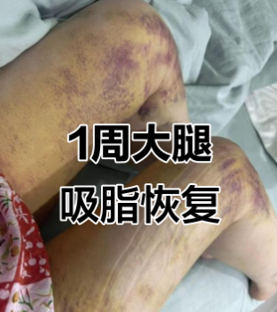 超声波减肥