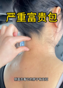 重庆超雅的超声波去富贵包的效果如何？