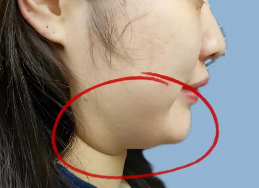 双下巴
