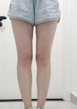 超声波减肥