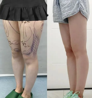 超声波减肥