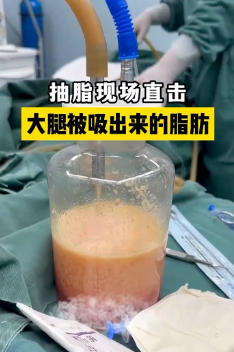 超声波减肥