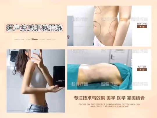 超声波减肥