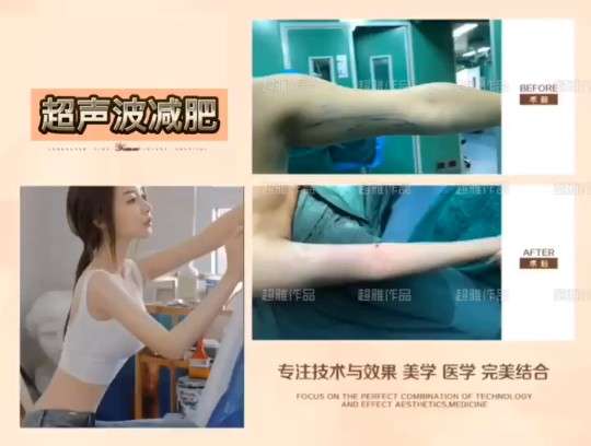 超声波减肥