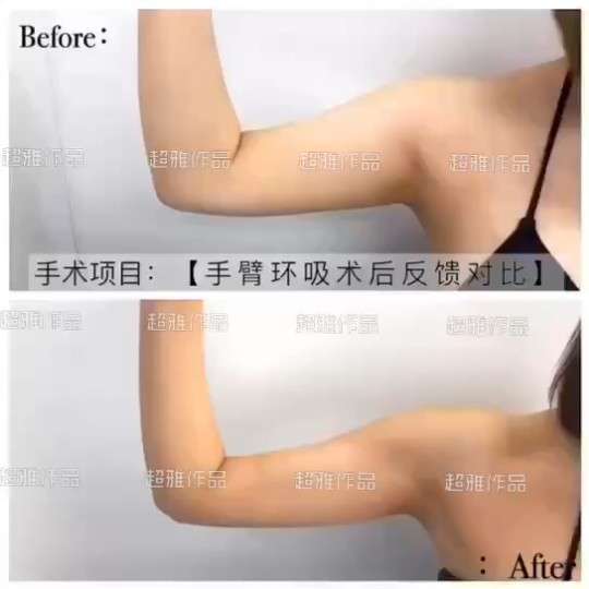 超声波减肥