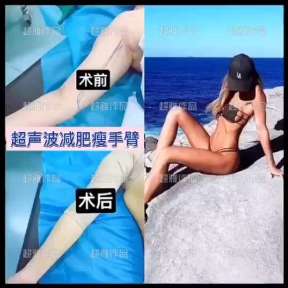 超声波减肥