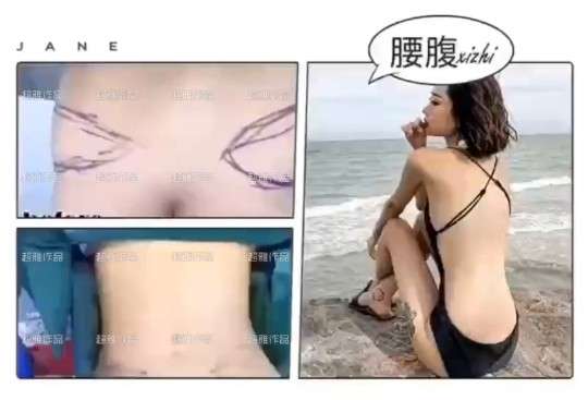 超声波减肥