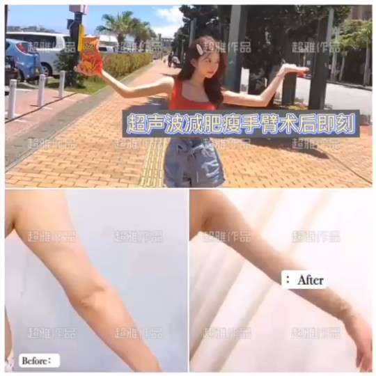 超声波减肥