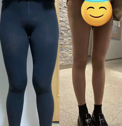 超声波减肥