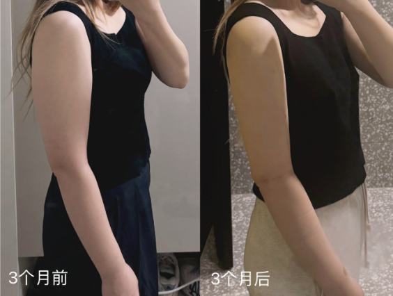 超声波减肥