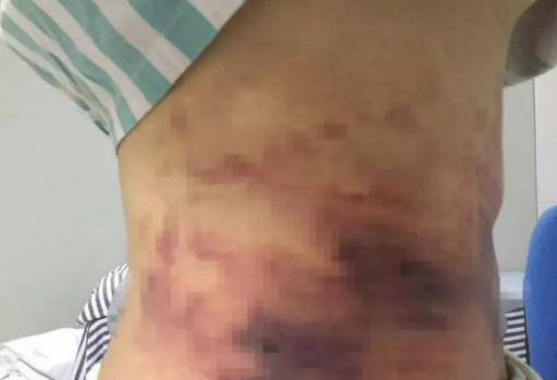 超声波减肥