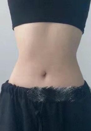 超声波减肥
