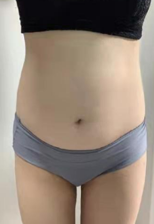 超声波减肥