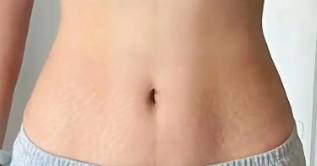 超声波减肥