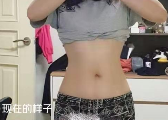 超声波减肥
