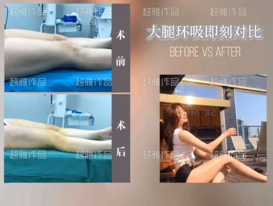 超声波减肥