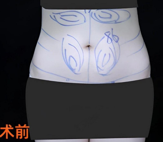 超声波减肥
