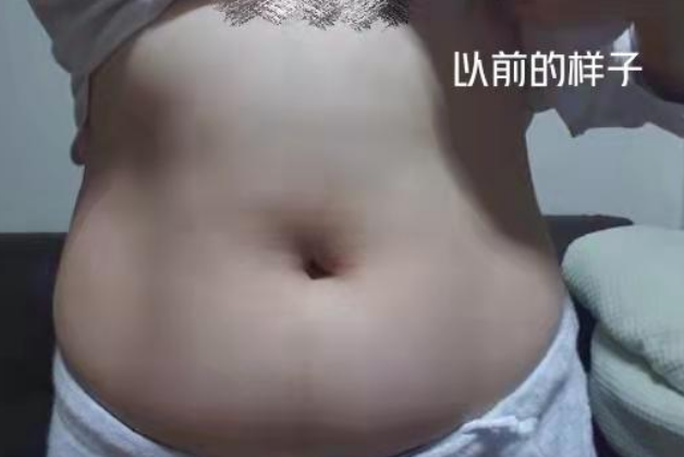 超声波减肥