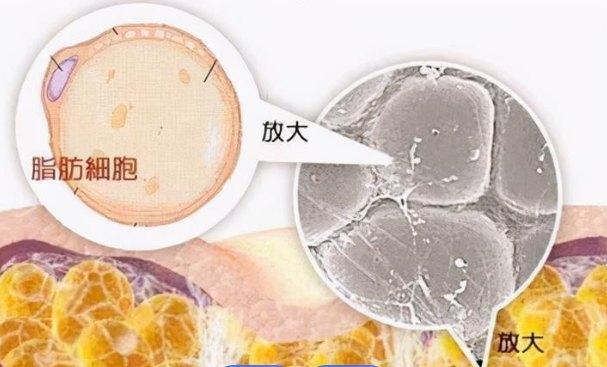 超声波减肥