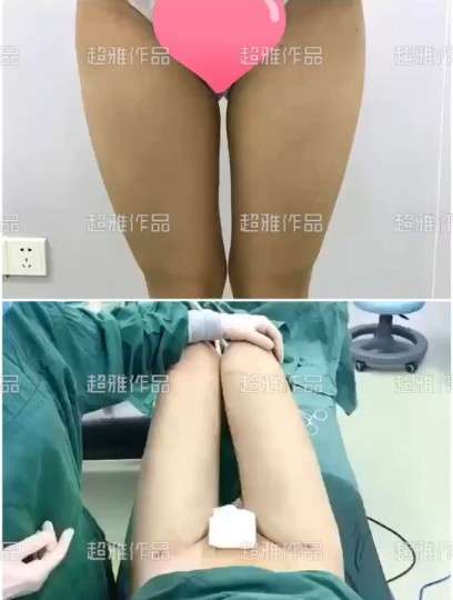 超声波减肥