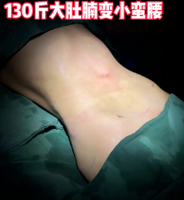 超声波减肥