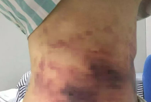 超声波减肥
