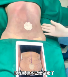超声波减肥
