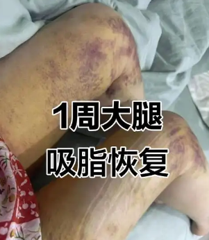 超声波减肥