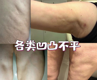 超声波减肥