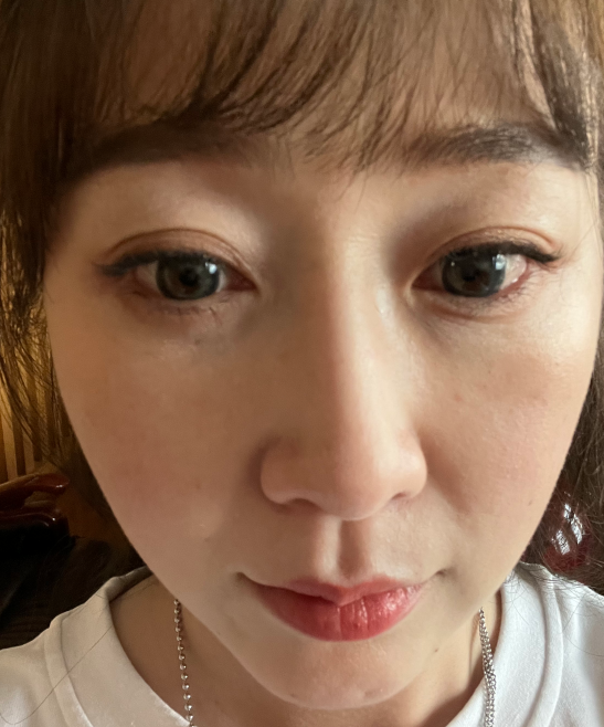 去眼袋手术