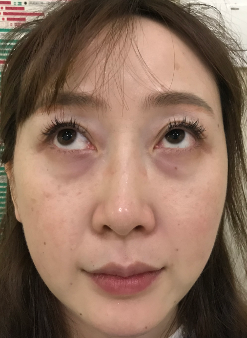 去眼袋手术