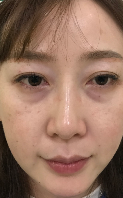 去眼袋手术