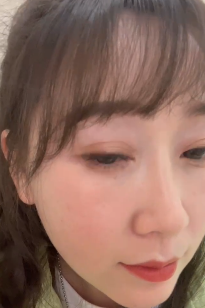去眼袋手术